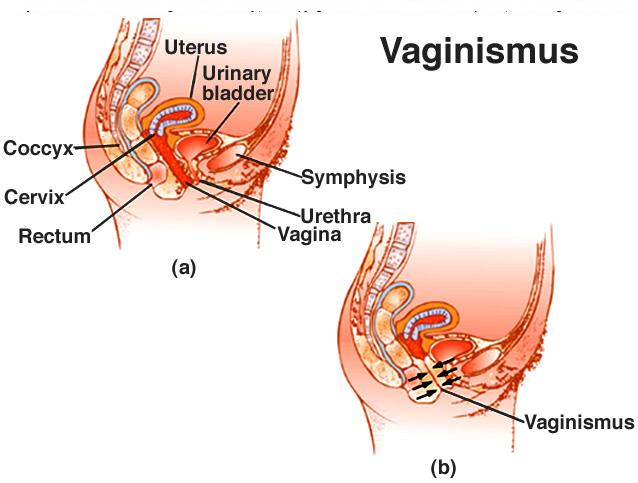 vaginismus.jpg