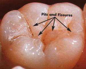 tooth-sealant-2.jpg