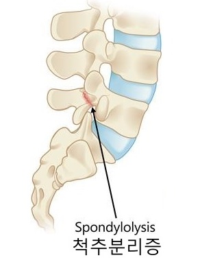 14-2-spondylolysis.jpg