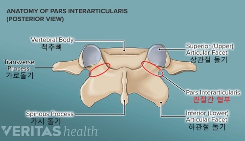 14-1-spondylolysis_AnatomyOfParsInter.jpg