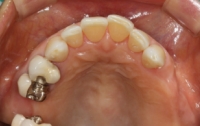 [의학]치과에서 설명하고 싶었던 것들4-3 : 보철치료 - 틀니